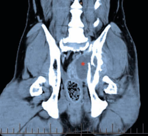 Figure 2a Hemipelvectomy