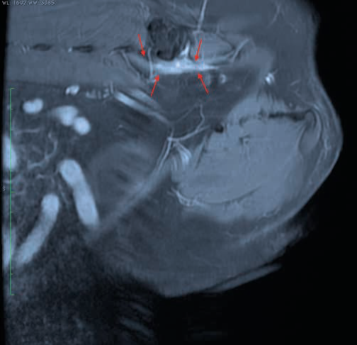 Figure 3a Hemipelvectomy