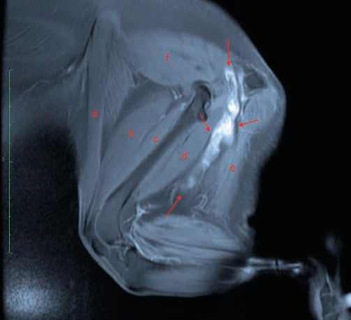 Figure 3b Hemipelvectomy