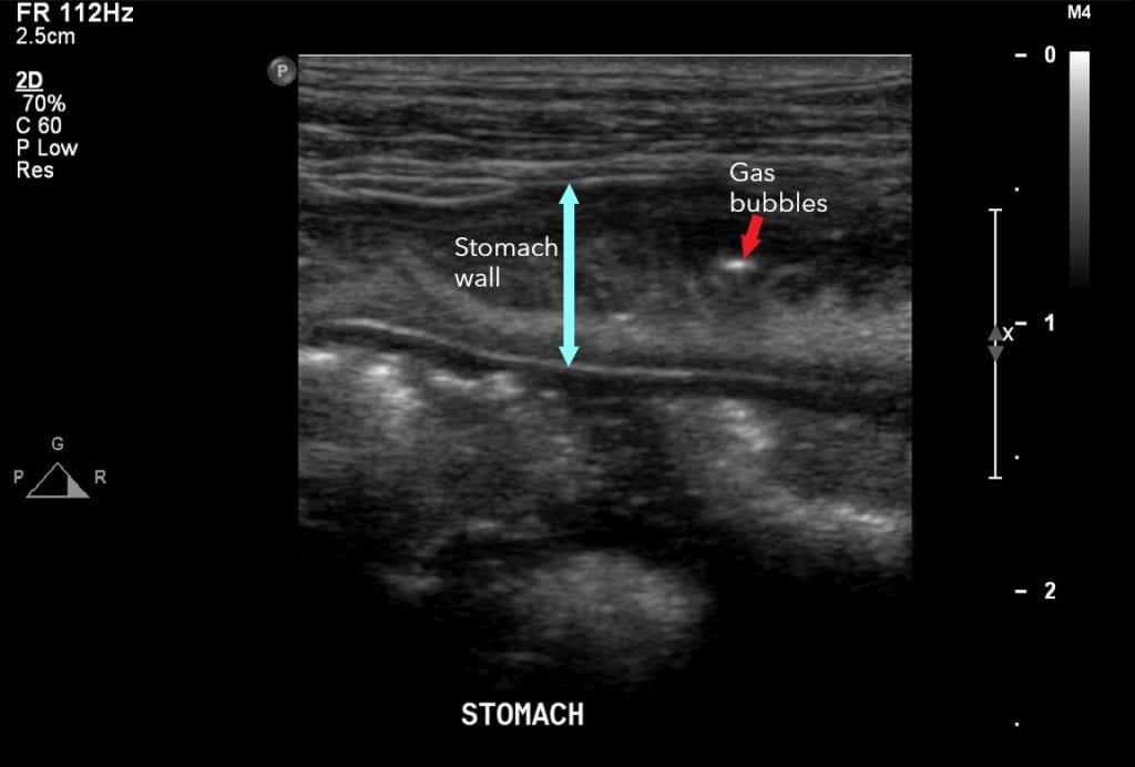 Ultrasound image of Maggie's severe emphysematous gastritis
