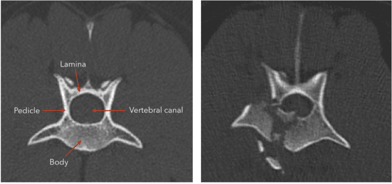 CT Scan showing cassie's compression fracture