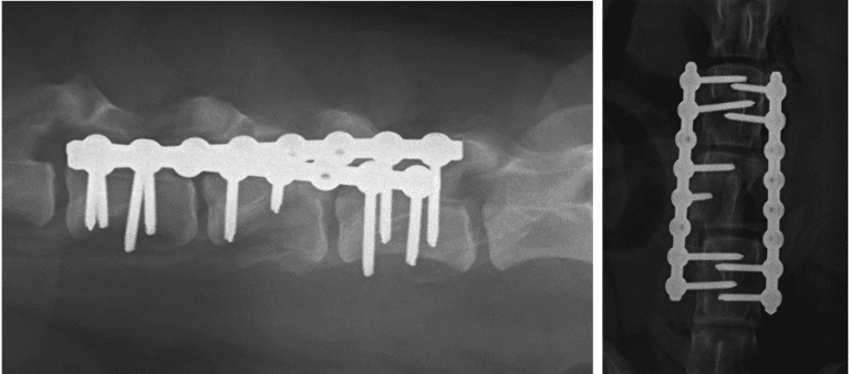 x-ray showing cassie's compression fracture